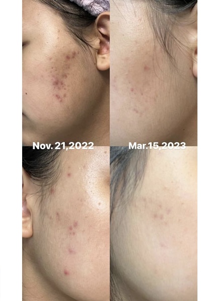 سرم ضدلک و جوش اکسیس وای