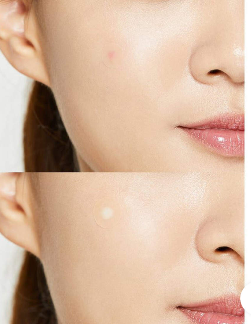 پچ ضد جوش کوزارکس